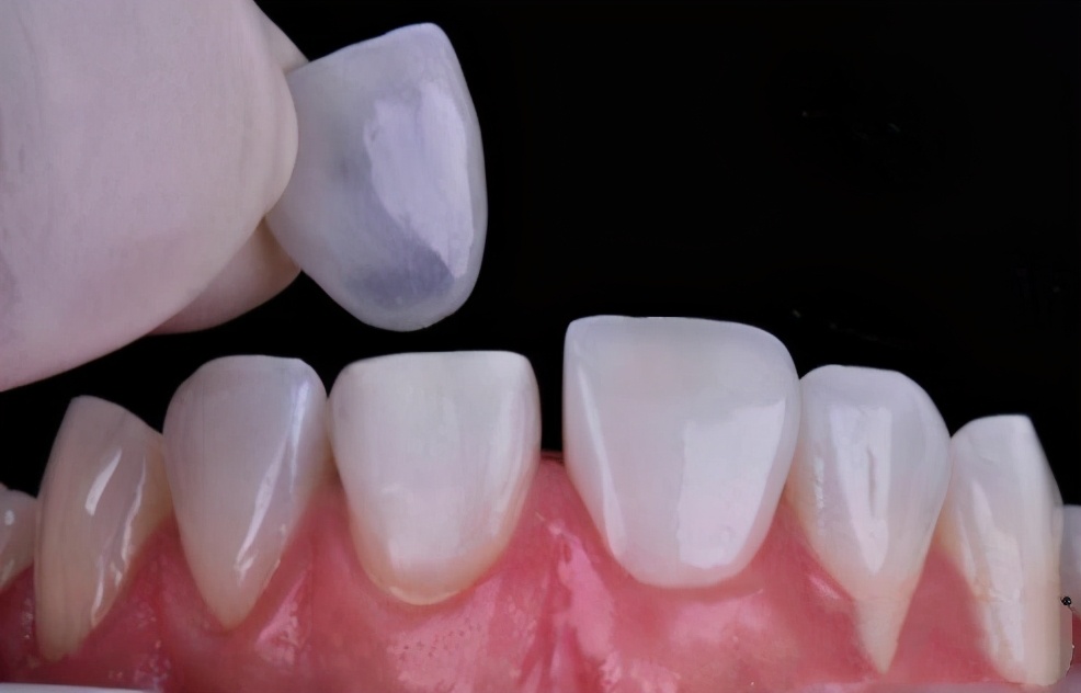 牙黄怎么办教你一招美白不花钱,如何解决牙黄最快最简单的方法