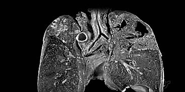 怀孕三个月后老公确诊肺结核,怀孕3个月我老公查出肺结核