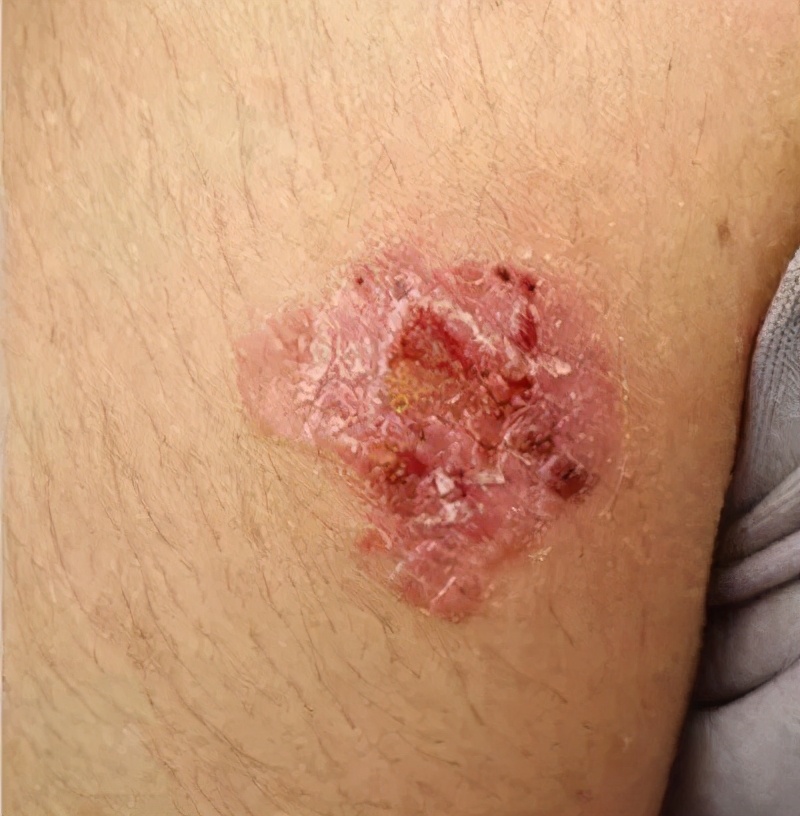 老人手长红斑,老人手上突然长了大块黑斑