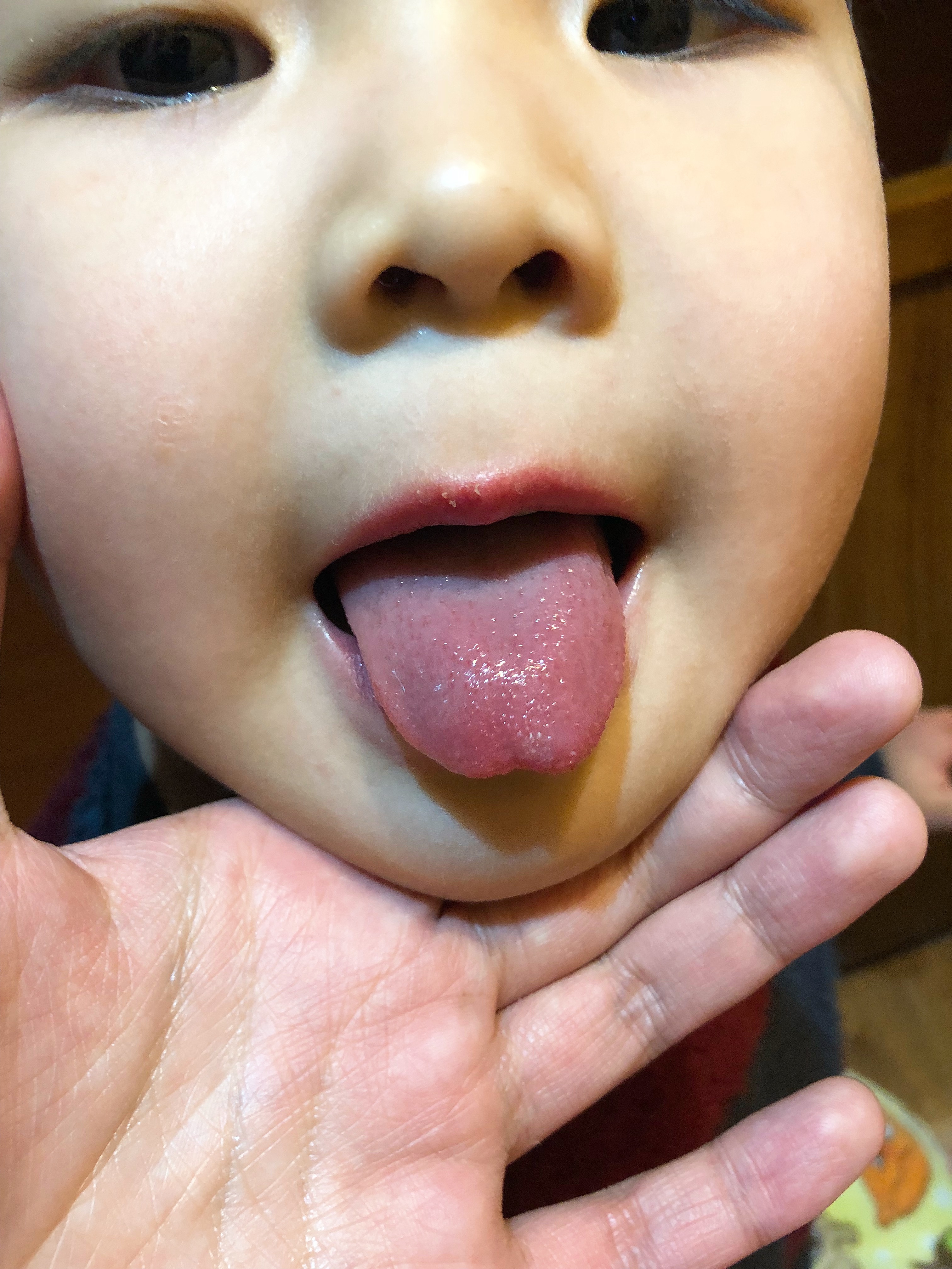 小儿白塞氏病的病因和症状,肉丸子得了什么病