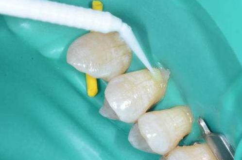 横着刷牙牙齿磨损能补吗,横向刷牙牙根磨损严重怎么修复