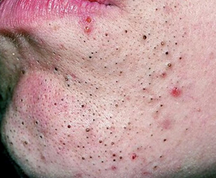 别折腾了，你这样去黑头是没有用的！