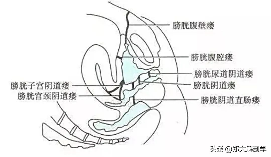 女性盆底功能障碍性疾病表现,盆底功能障碍会引起失眠吗