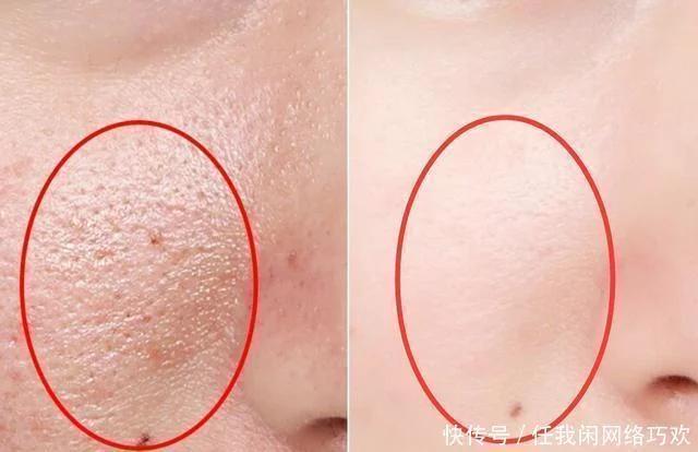 除螨去黑头药物,怎么除黑头啊