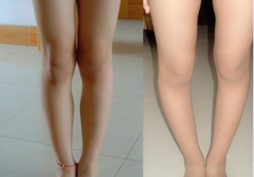 绑腿带对20岁矫正o型腿有用吗,1岁宝宝o型腿晚上睡觉绑腿有用吗