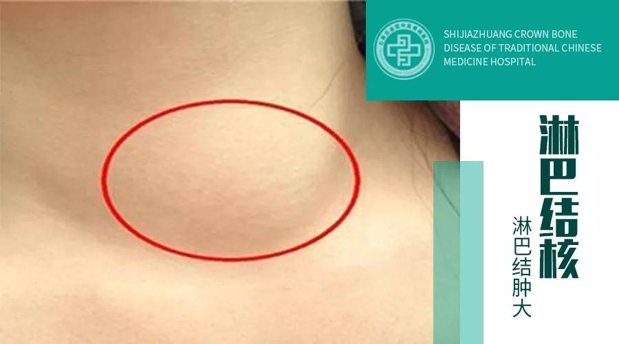 淋巴炎和淋巴结核的区别,淋巴炎和腮腺炎区别