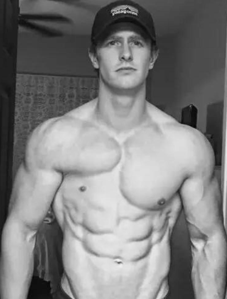 先天胸肌缺失锻炼回来了,poland综合症胸肌