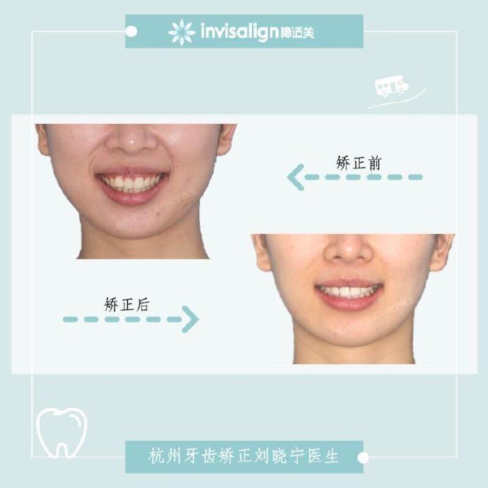 矫正牙齿如何改善露龈笑,矫正牙齿可以改善露龈笑吗