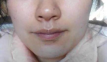 褐青色斑只能激光去除吗,激光皮秒真的能去除黑色素沉淀吗