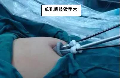 沈阳经脐弹孔腹腔镜手术,妇幼经脐单孔腹腔镜