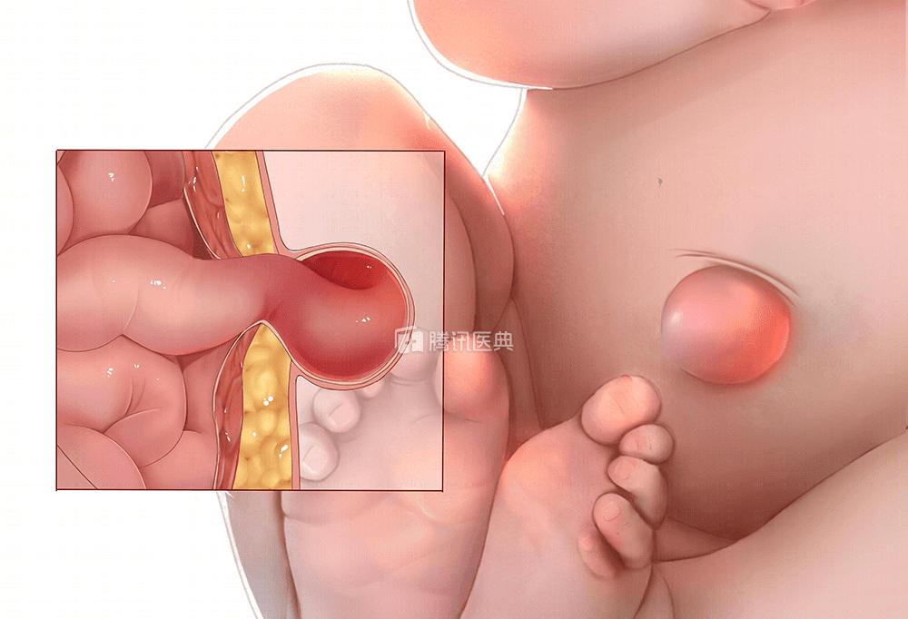 宝宝肚脐鼓起一个大包,宝宝肚脐鼓包