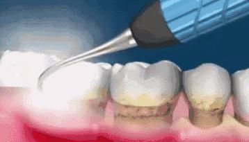 牙齿美白去黄的最快方法,什么牙膏美白牙齿去黄最好