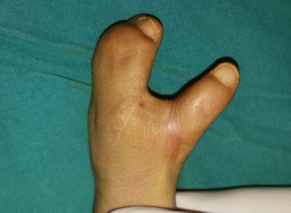 并指畸形免植皮案例,并指畸形