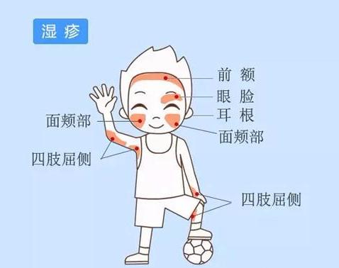 孩子湿疹加重？儿科医生教我3方法，湿疹越来越少，轻松赶跑它