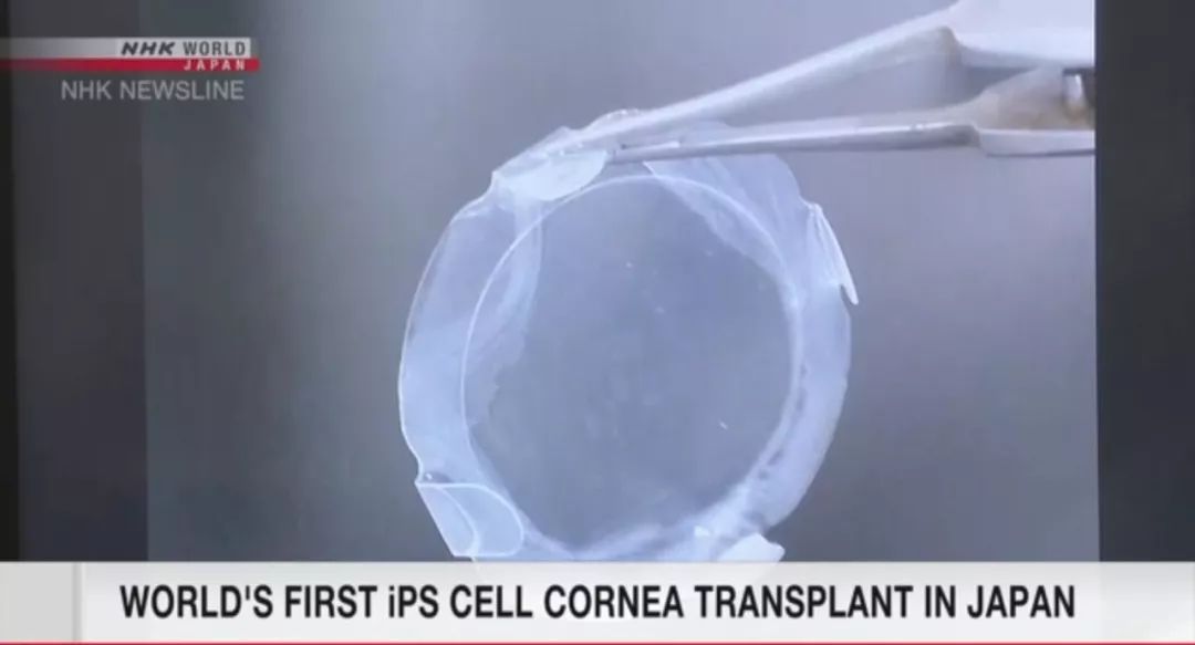 眼疾患者一大福音！全球首例iPS细胞培养角膜移植成功