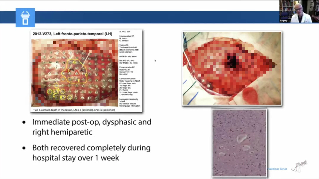 儿童癫痫治愈的真实案例,儿童难治性癫痫有哪些