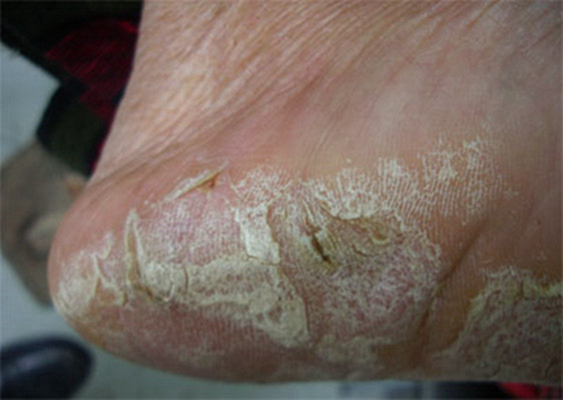 脚气反复发作其实是防治方法不对,脚气在治疗上的误区有哪些