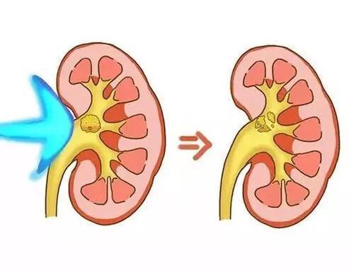 尿路结石治疗方法,女性尿路结石的治疗方法有哪些