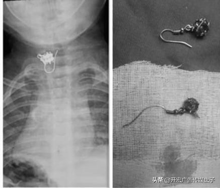 孩子误食异物的后果,小孩把耳环吞进去了怎么办