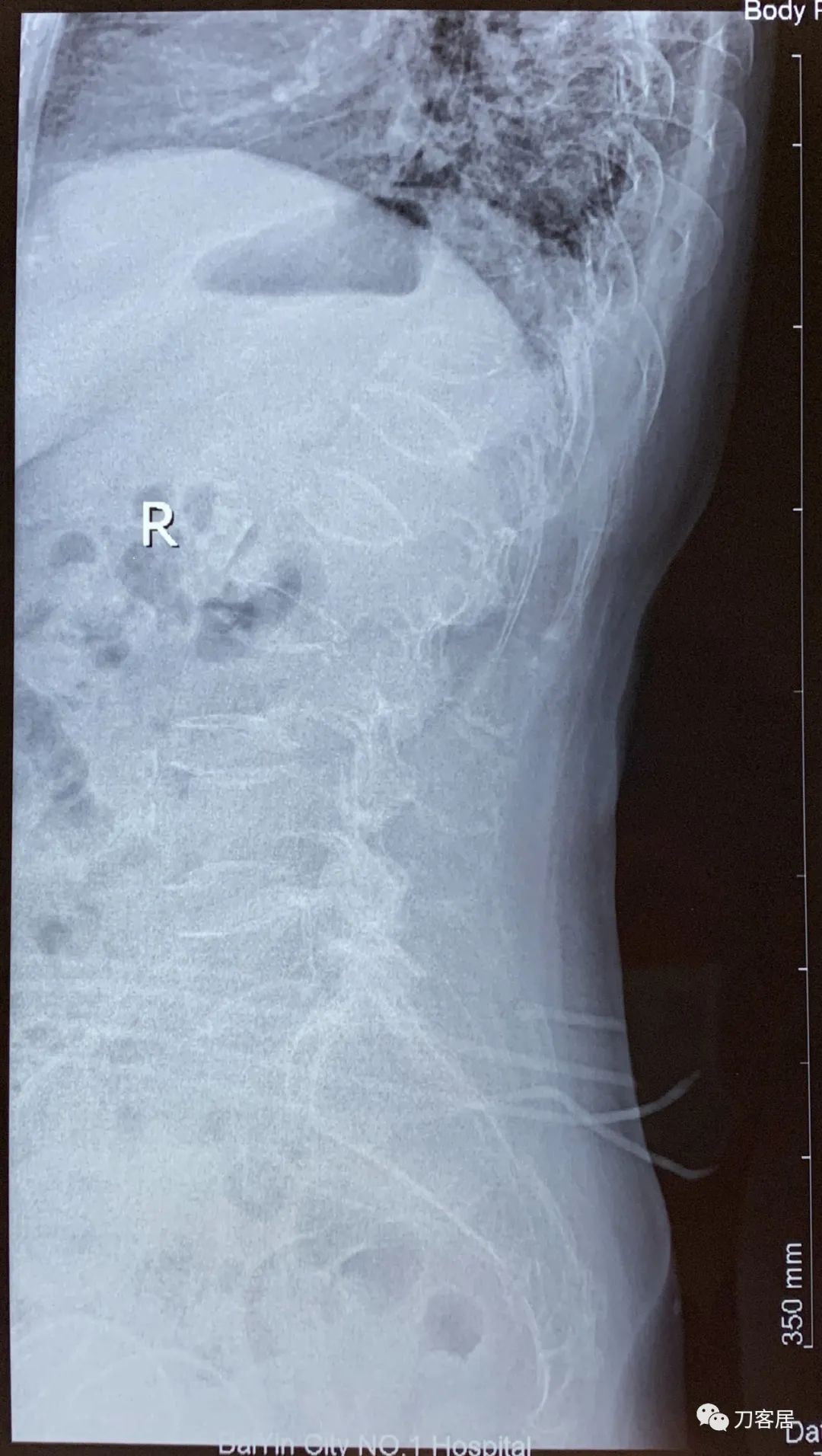 脊柱骨质疏松性压缩性骨折,老年骨质疏松压缩性骨折诊治