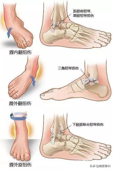 医生处理崴脚的全过程,崴脚后最专业的处理