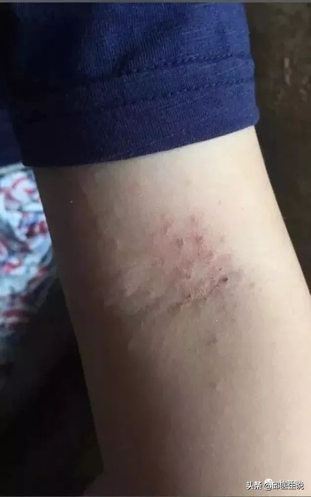 中医认为皮肤瘙痒是什么原因,治疗皮肤瘙痒的偏方医案