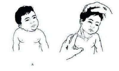 小孩脖子有点歪怎么矫正视频,孩子的脖子歪了怎么办