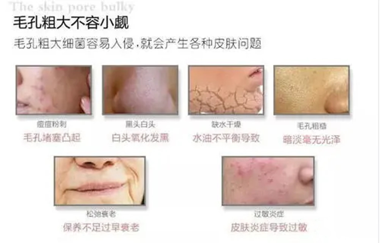 背部毛孔粗大像个马蜂窝,毛孔粗大修复日常