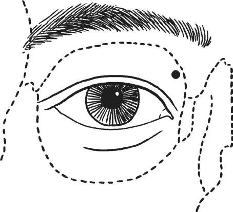 眼底黄斑病变针灸治疗,黄斑性眼病针灸治疗