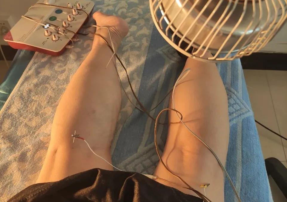 糖尿病神经病变吃甲钴胺能痊愈吗,糖尿病并发症有哪些手凉脚麻