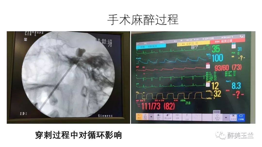 病例分享丨三叉神经节微球囊压迫术的麻醉管理