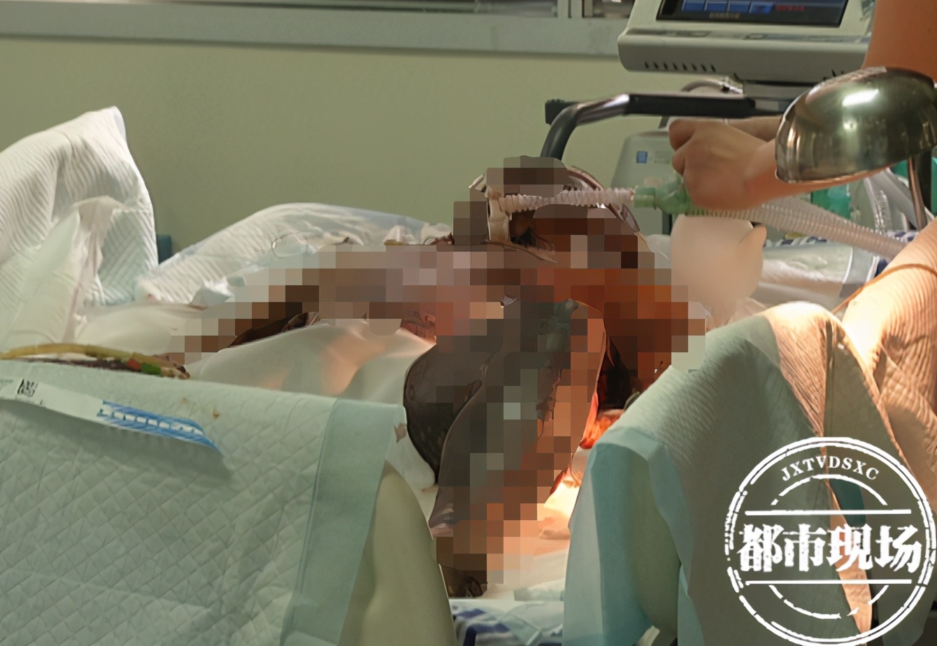 安徽29岁小伙遭大面积烧伤,男子钓鱼全身烧伤医疗费还要40万