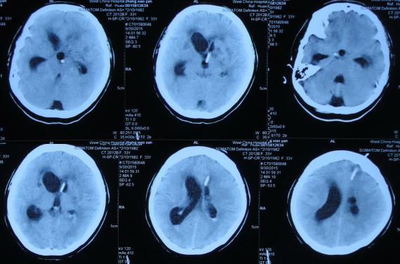 结核性脑积水,脑膜炎脑积水要治疗多久