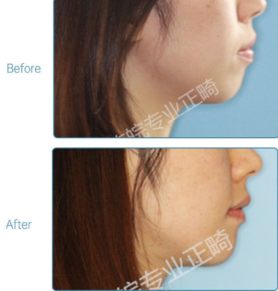 杭州牙齿矫正的全过程,杭州牙齿矫正哪个医生最好