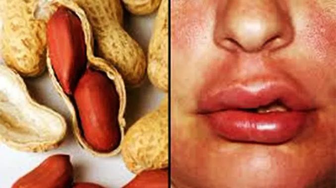 生花生过敏但熟花生不过敏,花生过敏吃了花生皮有事吗