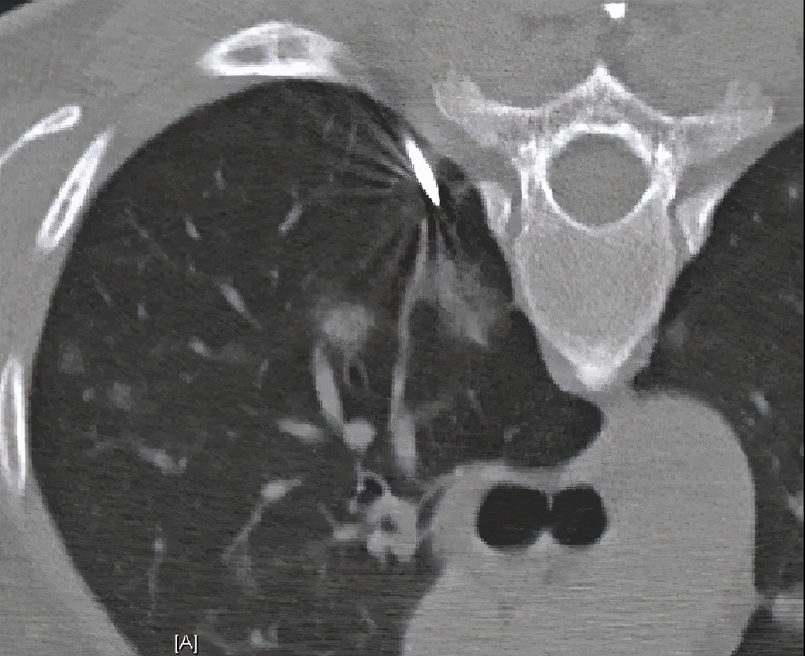 特发性肺炎一直用激素治疗,机化性肺炎住院治疗使用什么药物