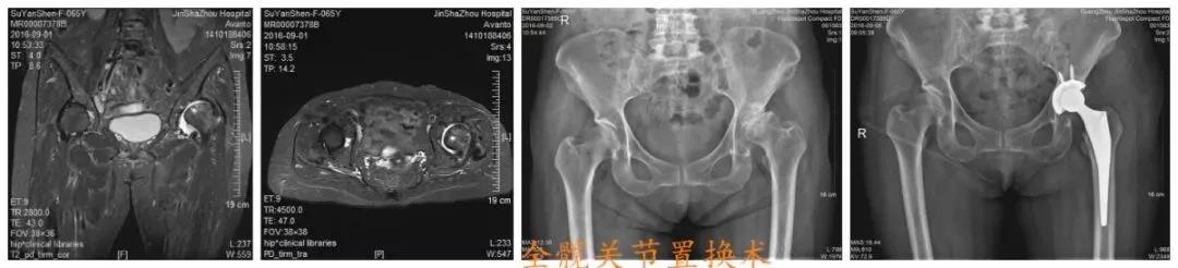 伤害老年人的第三大杀手！家中有老人跌到，髋部骨折该如何处理？