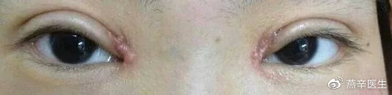 疤痕增生手术去除还会增生吗,术后多久会排除瘢痕增生