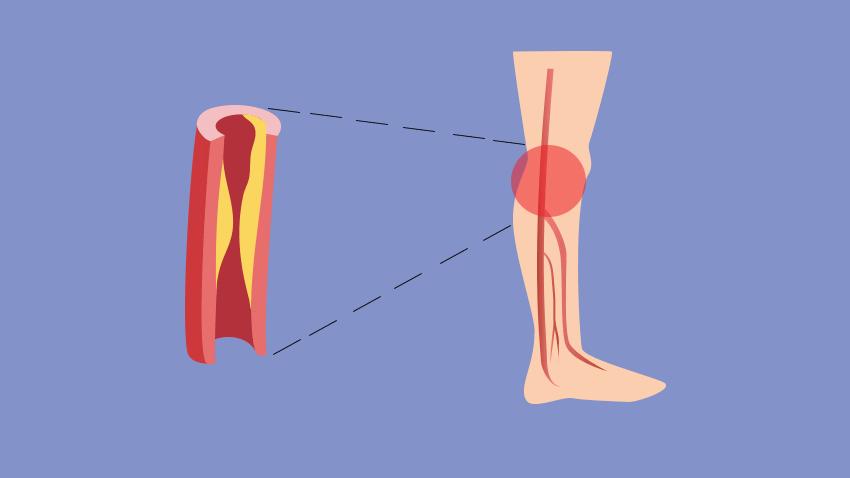老年人腿脚无力要怎么避免,专治老年人下肢无力的方法