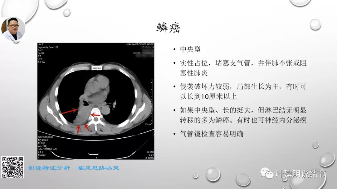 叶建明谈肺实性小结节视频,廖正银教授谈肺结节