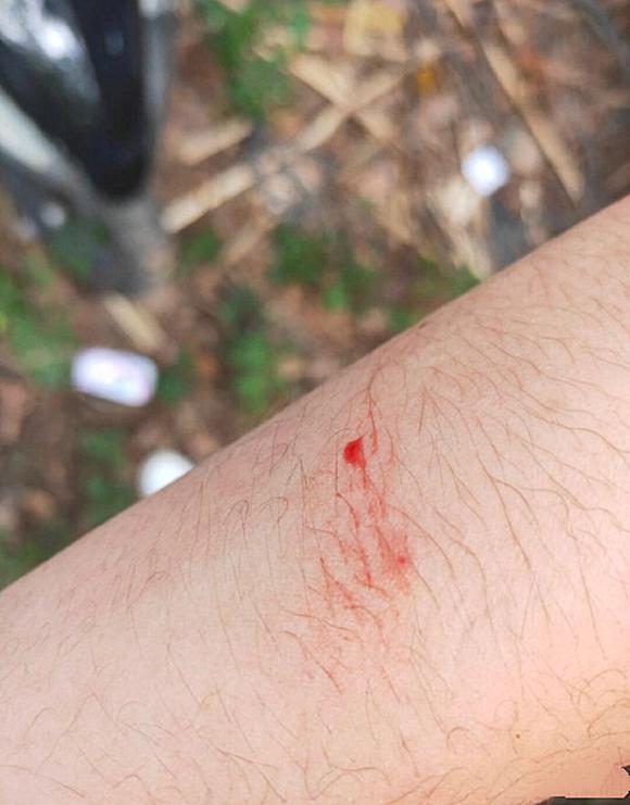 苍蝇一碰就跟针扎一样疼,男子手臂爬进去一只虫子