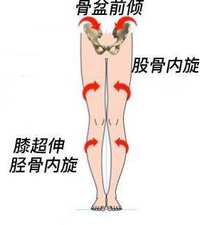 膝关节超伸原因以及调理方法