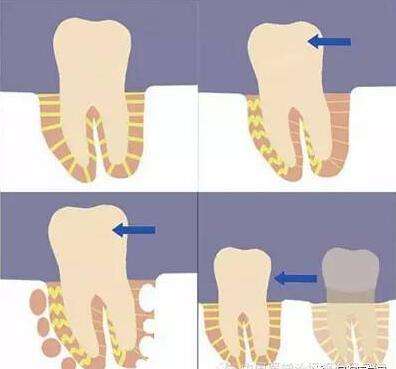 牙齿矫正选择了就不要轻易放弃,牙齿矫正刚开始就后悔了怎么办