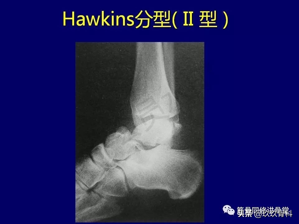 距骨骨折后遗症,距骨骨折怎么办