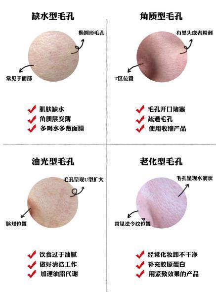 干皮毛孔粗大黑头涂什么改善,男士毛孔粗大有黑头怎么改善