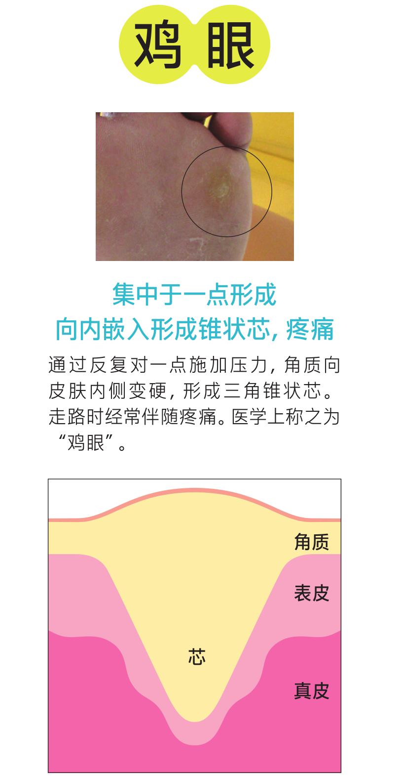 脚底的老茧怎么才能根治,老茧下的鸡眼