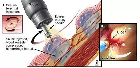内镜下消化道出血的治疗简报,消化道出血内镜下止血治疗处方