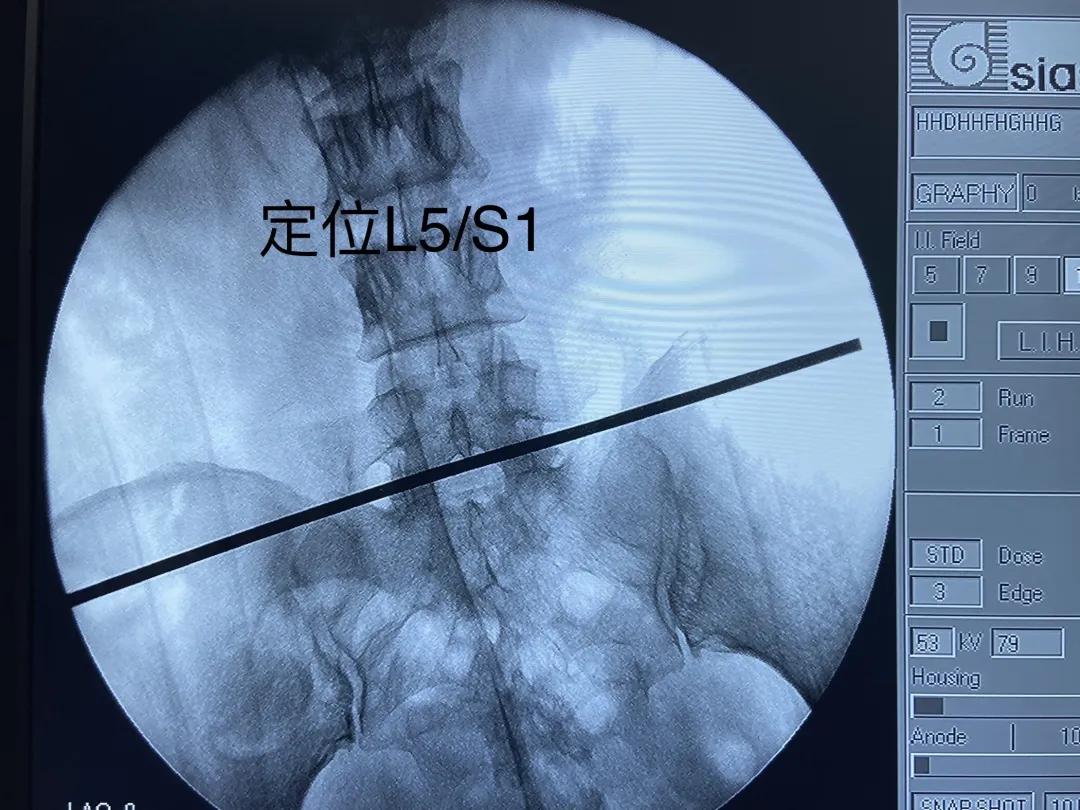 渭南治腰间盘突出哪家最好,脊柱神经外科手术