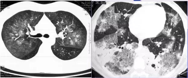 肺部ct十大征象,肺部ct正常图和异常图的区别