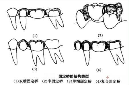烤瓷牙桥适用于什么,烤瓷桥好处